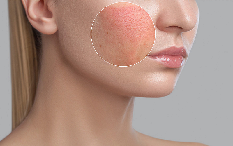 pollen allergy season protect skin